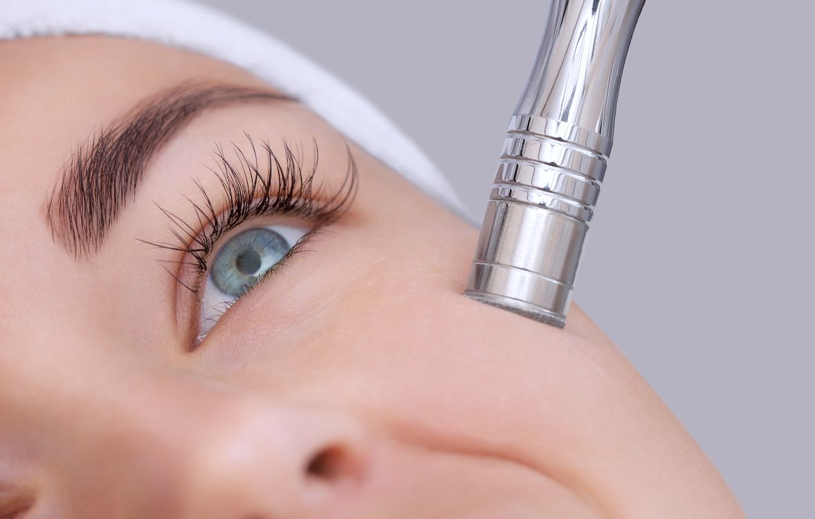 What is Microdermabrasion?